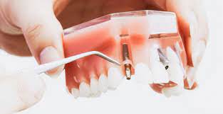 How to Choose the Best Dental Implant Clinic